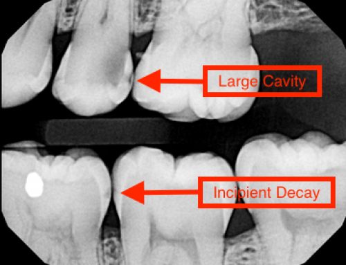 What Is A Dental Cavity?